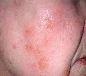 Allergic contact dermatitis
